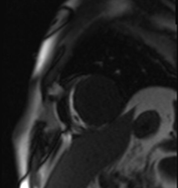File:Acute anteroseptal myocardial infarction (Radiopaedia 68409-77945 Short axis (mid ventricular) Perfusion 5).jpg