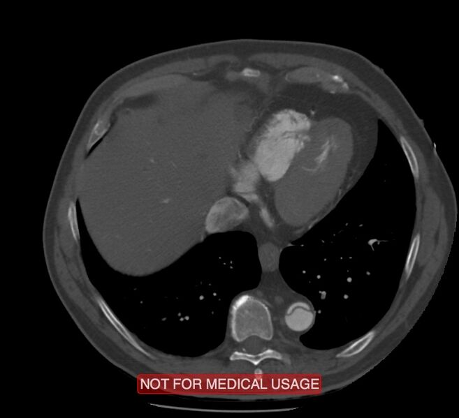 File:Acute aortic dissection - Stanford type A (Radiopaedia 40661-43285 Axial C+ arterial phase 57).jpg