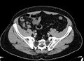 Acute appendicitis (Radiopaedia 13030-13091 Axial non-contrast 51).jpg