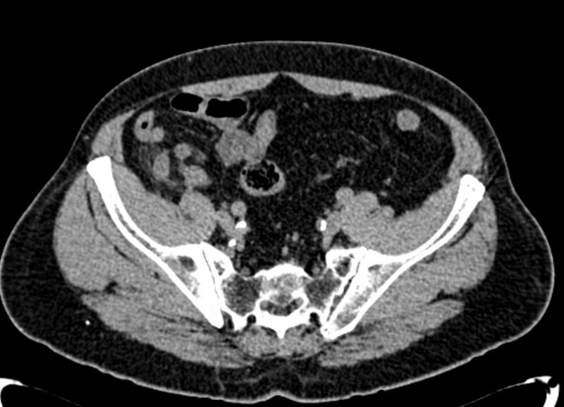 File:Acute appendicitis (Radiopaedia 13030-13091 Axial non-contrast 51).jpg