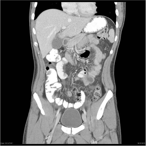 File:Acute appendicitis (Radiopaedia 25364-25615 C+ portal venous phase 8).jpg