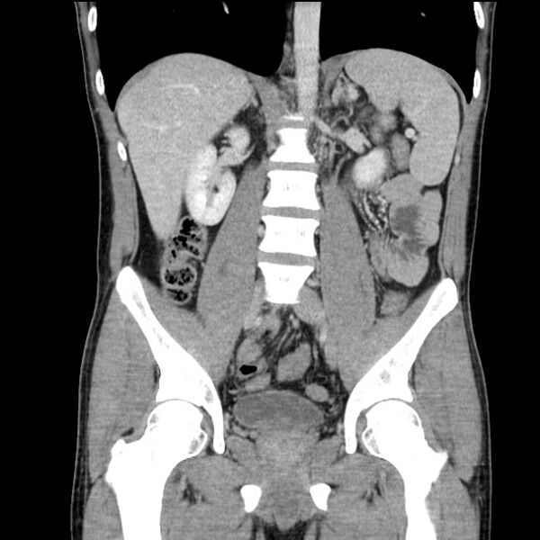 File:Acute appendicitis (Radiopaedia 27049-27227 Coronal C+ portal venous phase 32).jpg
