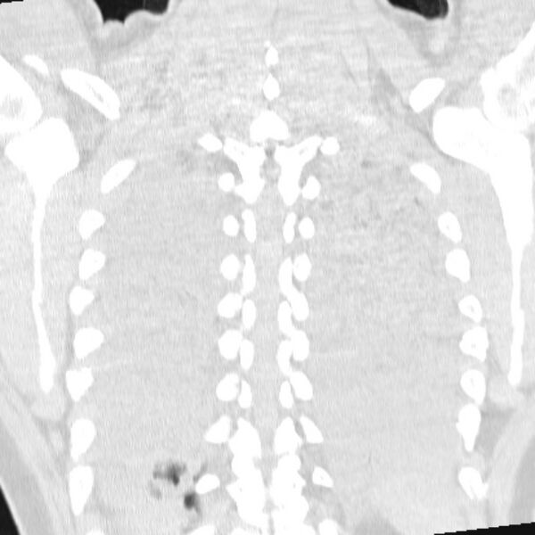File:Acute aspiration pneumonitis (Radiopaedia 33605-34703 Coronal lung window 65).jpg