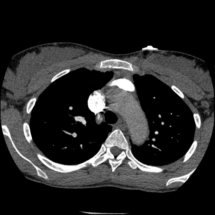 Acute chest syndrome - sickle cell disease (Radiopaedia 42375-45499 Axial C+ CTPA 56).jpg