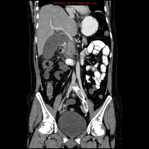 File:Acute gangrenous cholecystitis (Radiopaedia 10123-10661 Coronal C+ portal venous phase 15).jpg