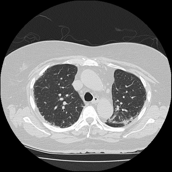 File:Acute interstitial pneumonitis (Radiopaedia 45404-49452 Axial lung window 31).jpg