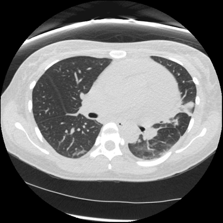 Acute lupus nephritis (Radiopaedia 45832-50107 Axial lung window 40).jpg