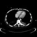 Acute myocardial infarction in CT (Radiopaedia 39947-42457 Axial C+ portal venous phase 7).jpg