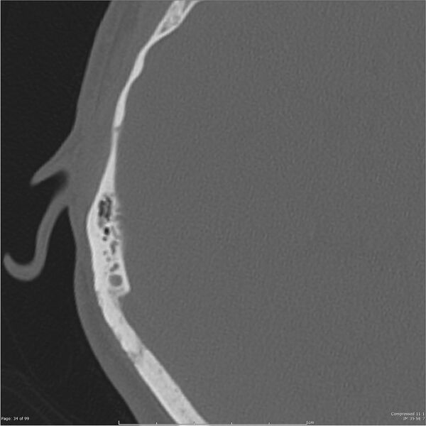 File:Acute otomastoiditis (Radiopaedia 28276-28512 Axial PTB bone window reformat 14).jpg