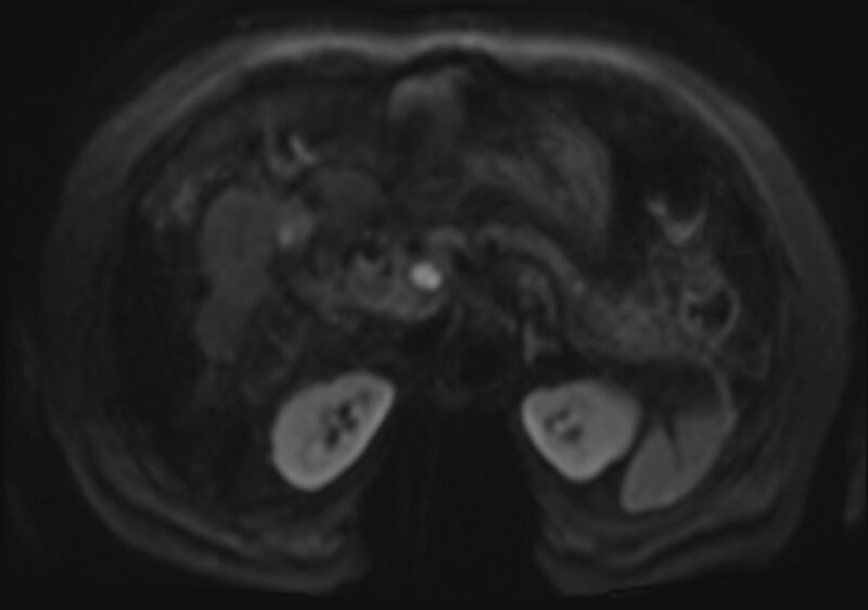 File:Acute portal vein thrombosis (Radiopaedia 73198-83925 Axial DWI 46).jpg