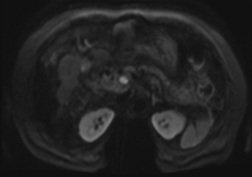 Acute portal vein thrombosis (Radiopaedia 73198-83925 Axial DWI 46).jpg