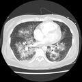 Acute pulmonary edema on CT (Radiopaedia 33582-34672 Axial lung window 33).jpg