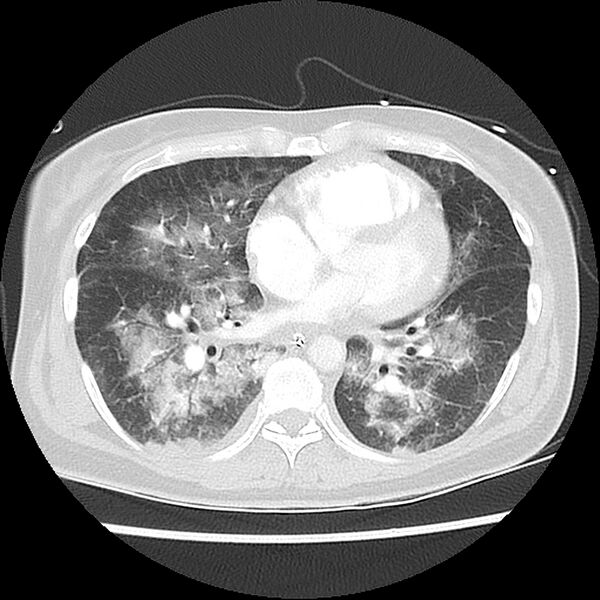 File:Acute pulmonary edema on CT (Radiopaedia 33582-34672 Axial lung window 33).jpg