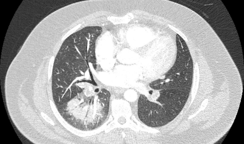 Acute pulmonary embolism with pulmonary infarcts (Radiopaedia 77688-89908 Axial lung window 66).jpg