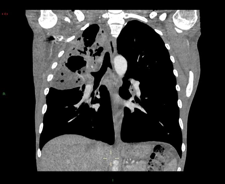 File:Acute right lung abscess (Radiopaedia 34806-36258 Coronal C+ arterial phase 25).jpg