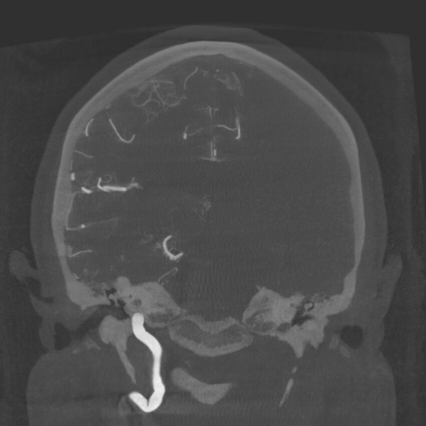 Acute subarachnoid hemorrhage and accessory anterior cerebral artery (Radiopaedia 69231-79010 Coronal arterial - MIP 60).jpg