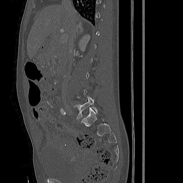 File:Acute vertebral body compression fractures (Radiopaedia 31757-32693 Sagittal bone window 39).jpg