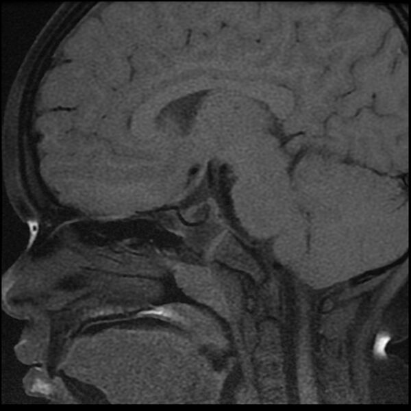 File:Adamantinomatous craniopharyngioma (Radiopaedia 77407-89529 Sagittal T1 fat sat 5).jpg