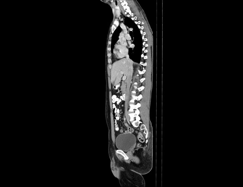 File:Addison disease (Radiopaedia 49318-54412 Sagittal C+ portal venous phase 40).jpg