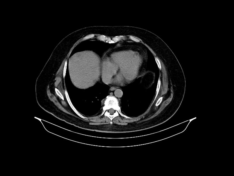File:Adenocarcinoma of pancreas with hepatic metastasis (Radiopaedia 64332-73122 Axial non-contrast 14).jpg