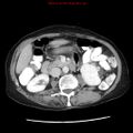 Adenocarcinoma of the colon (Radiopaedia 8191-9039 Axial liver window 33).jpg