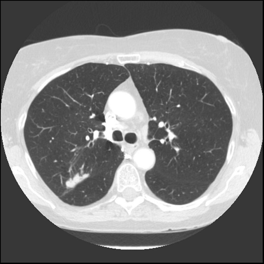 Adenocarcinoma of the lung (Radiopaedia 41015-43755 Axial lung window 44).jpg