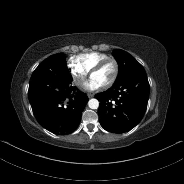File:Adenocarcinoma of the lung (Radiopaedia 44205-47803 Axial C+ portal venous phase 57).jpg