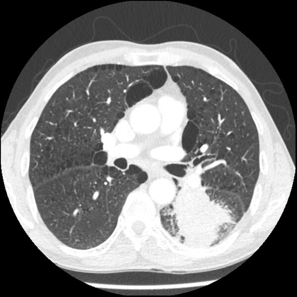 File:Adenocarcinoma of the lung - micropapillary predominant (Radiopaedia 42446-45563 C 40).jpg