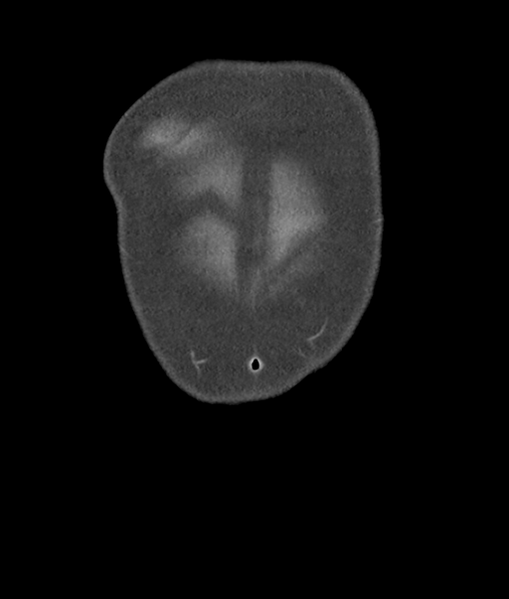 File:Adenocarcioma of rectum- T1 lesion (Radiopaedia 36921-38547 Coronal C+ portal venous phase 3).png
