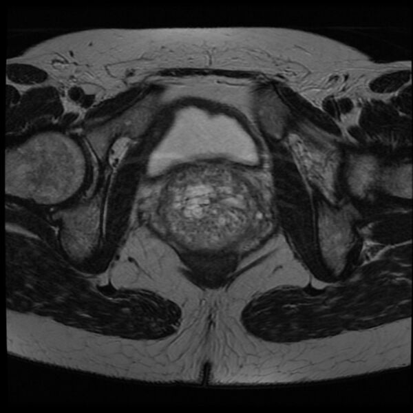 File:Adenoma malignum of the cervix (Radiopaedia 24460-24765 C 21).jpg