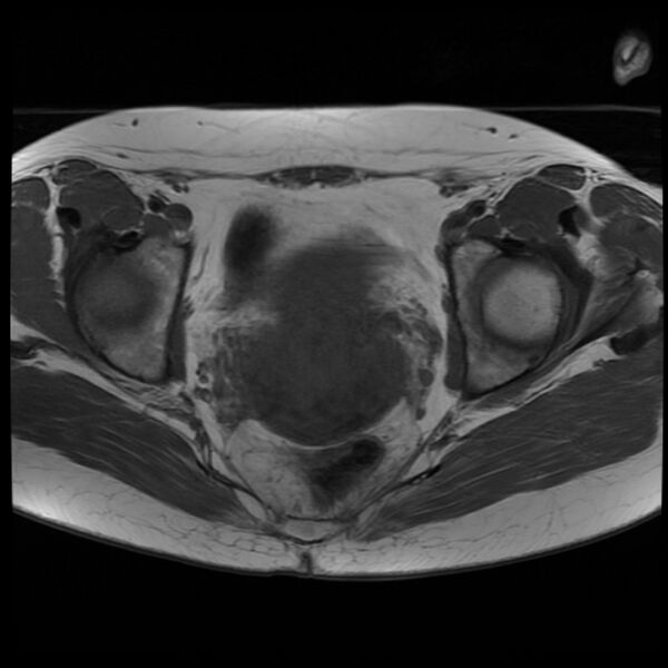 File:Adenoma malignum of the cervix (Radiopaedia 24460-24765 T1 12).jpg