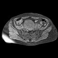 Adenomyoma of the uterus (huge) (Radiopaedia 9870-10438 Axial T1 fat sat 22).jpg