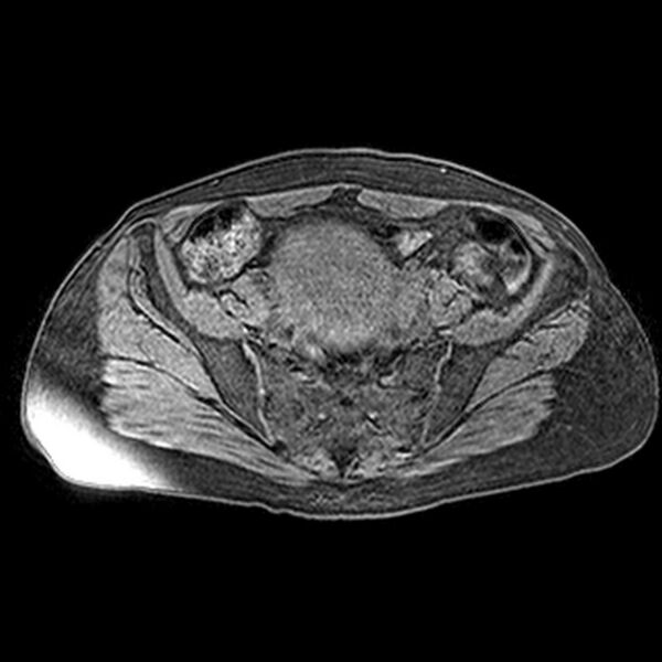 File:Adenomyoma of the uterus (huge) (Radiopaedia 9870-10438 Axial T1 fat sat 22).jpg