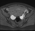 Adenomyosis - ovarian endometriomas (Radiopaedia 67031-76350 Axial T1 fat sat 13).jpg