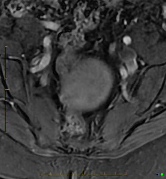 File:Adenomyosis uterus with hematometra (Radiopaedia 45779-50011 Axial T1 C+ fat sat 3).jpg