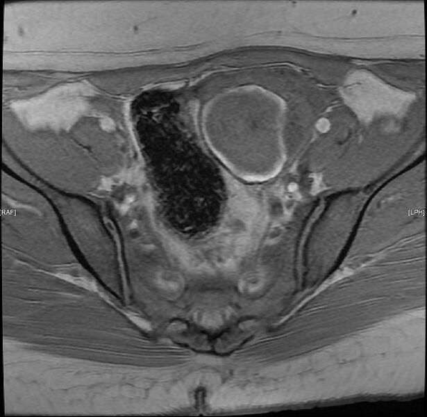 File:Adenomyosis with endometrioma (Radiopaedia 6753-7952 Axial T1 1).jpg