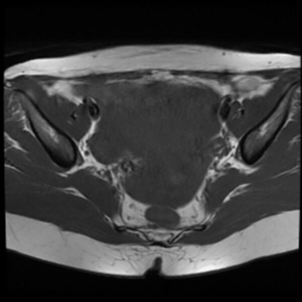 File:Adenomyosis within a septate uterus (Radiopaedia 69963-79981 Axial T1 15).jpg