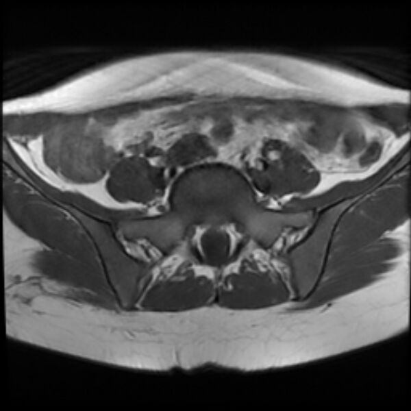 File:Adenomyosis within a septate uterus (Radiopaedia 69963-79981 Axial T1 6).jpg