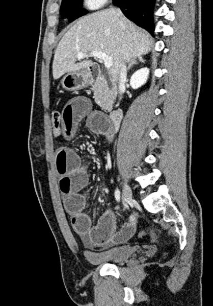 File:Adhesional small bowel obstruction (Radiopaedia 58900-66131 Sagittal C+ portal venous phase 102).jpg