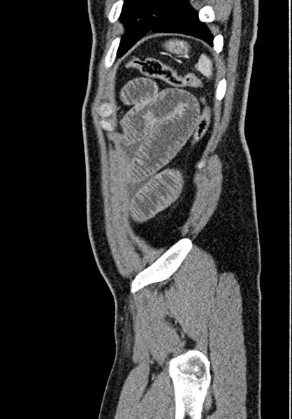 File:Adhesional small bowel obstruction (Radiopaedia 58900-66131 Sagittal C+ portal venous phase 224).jpg