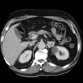 Adrenal hemangioma (Radiopaedia 11039-11445 Axial C+ portal venous phase 8).jpg
