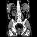 Adrenal myelolipoma (Radiopaedia 41843-44834 Coronal non-contrast 13).jpg