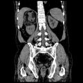 Adrenal myelolipoma (Radiopaedia 41843-44834 Coronal non-contrast 15).jpg