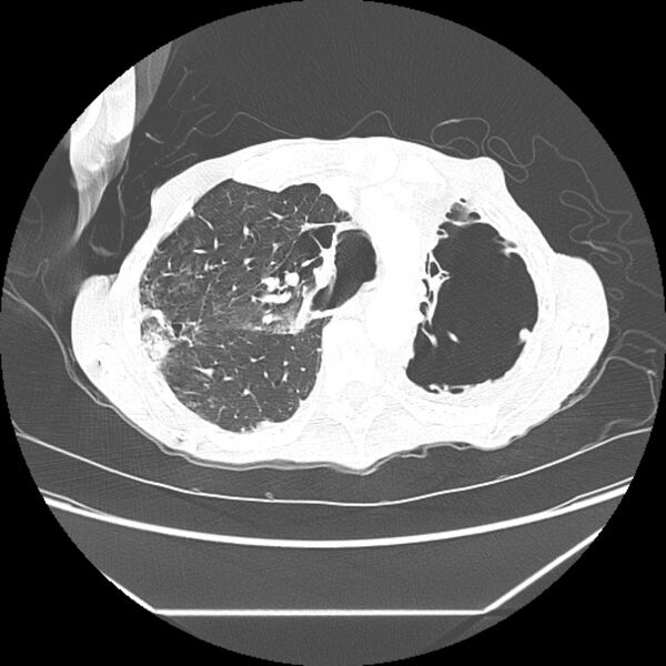 File:Advanced pulmonary tuberculosis (Radiopaedia 8599-9431 Axial lung window 15).jpg