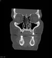 Ameloblastoma (Radiopaedia 18115-17901 Axial bone window 21).jpg
