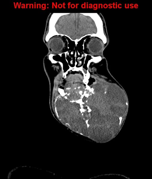 File:Ameloblastoma (Radiopaedia 33126-34164 D 18).jpg