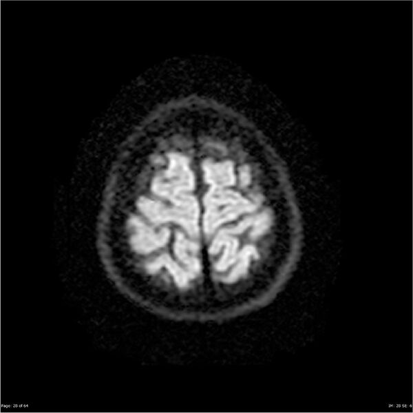 File:Amnestic syndrome secondary to hypoxic brain injury (Radiopaedia 24743-25004 DWI 28).jpg