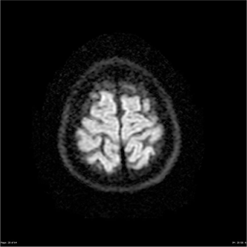 Amnestic syndrome secondary to hypoxic brain injury (Radiopaedia 24743-25004 DWI 28).jpg