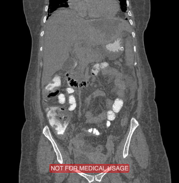 File:Amoebic enterocolitis with liver abscess (Radiopaedia 35100-36609 B 80).jpg