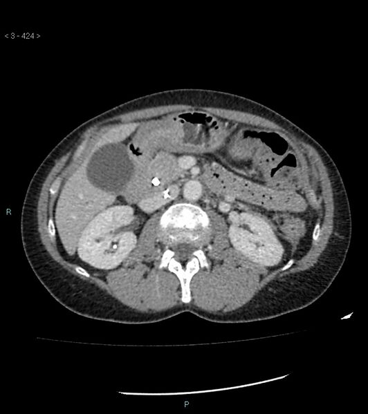 File:Ampulla of Vater metastasis (Radiopaedia 27820-28069 A 62).jpg